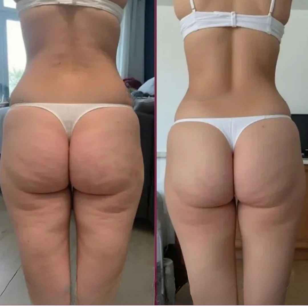Masajeador Ventosa para Celulitis: Siente Alivio y Nota La Diferencia