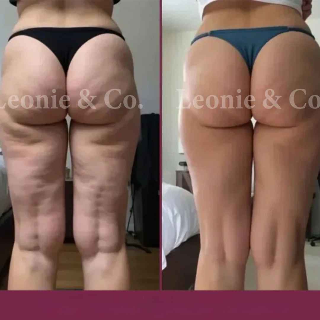 Masajeador Ventosa para Celulitis: Siente Alivio y Nota La Diferencia