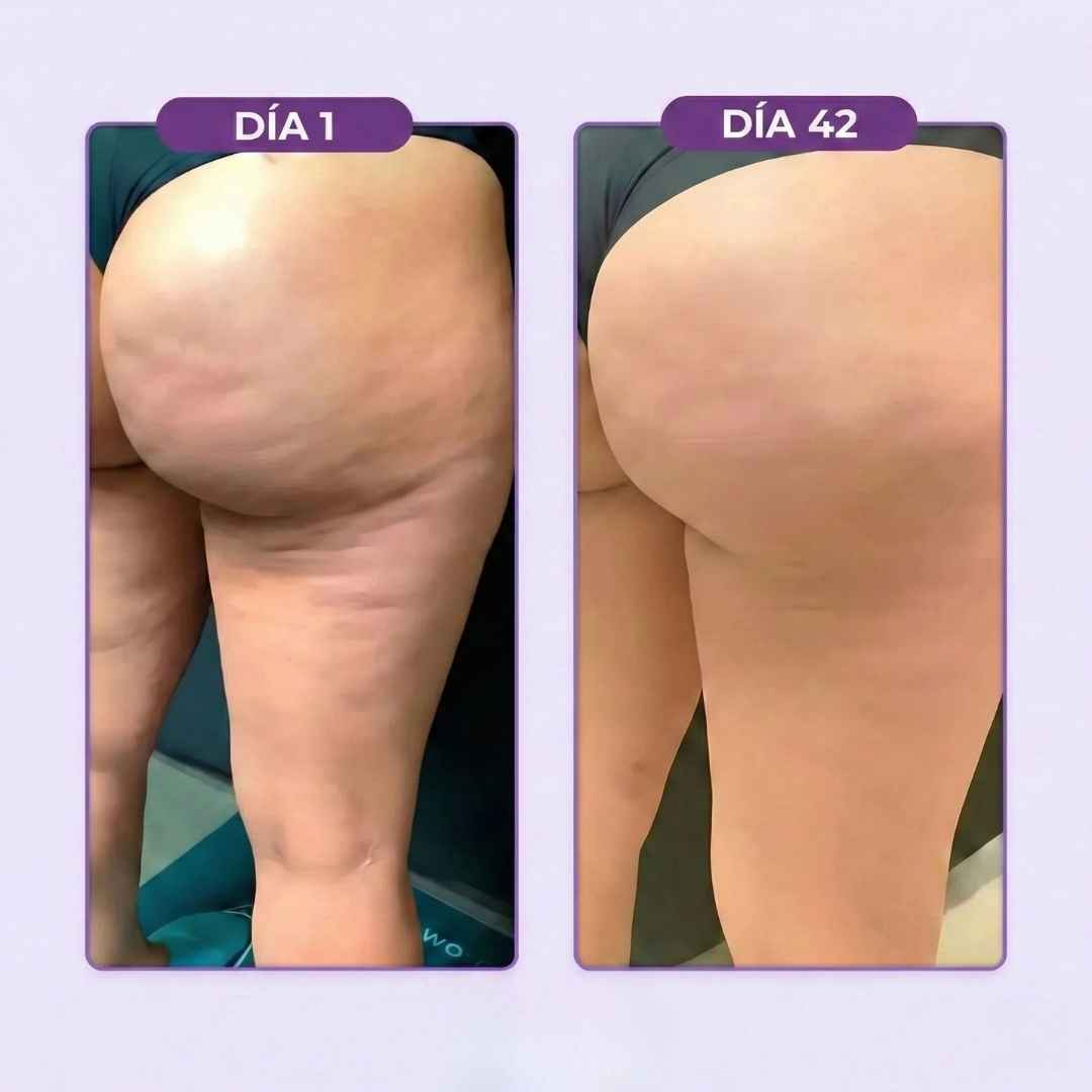 Masajeador Ventosa para Celulitis: Siente Alivio y Nota La Diferencia